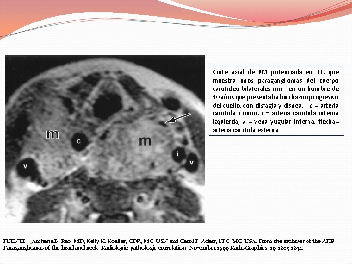 Corte axial de RM potenciada en T 1, que muestra unos paragangliomas del cuerpo