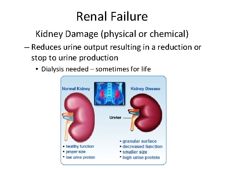 Renal Failure Kidney Damage (physical or chemical) – Reduces urine output resulting in a
