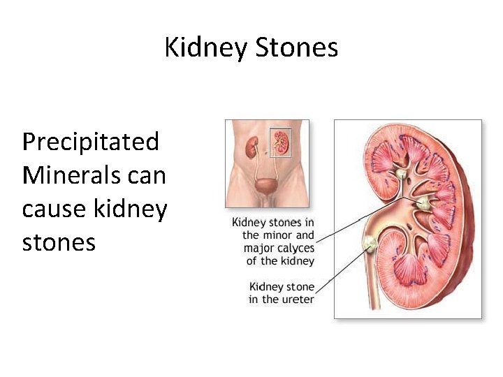 Kidney Stones Precipitated Minerals can cause kidney stones 