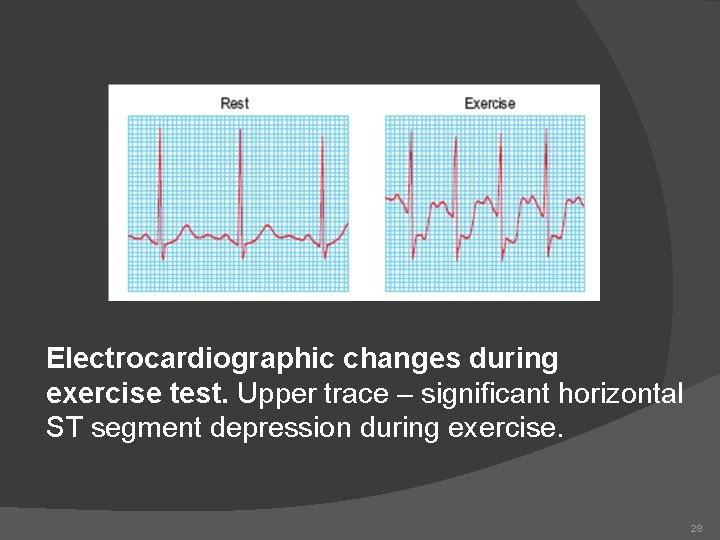 Electrocardiographic changes during exercise test. Upper trace – significant horizontal ST segment depression during