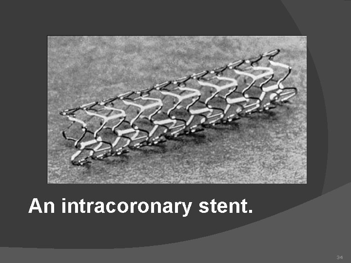 An intracoronary stent. 34 