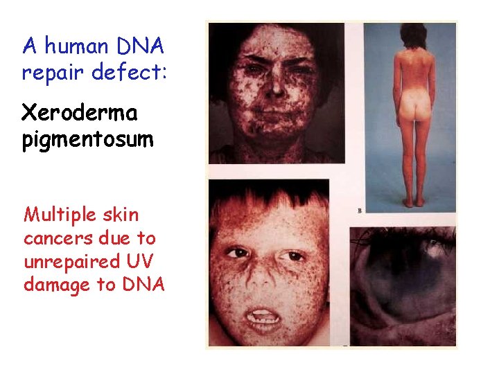 A human DNA repair defect: Xeroderma pigmentosum Multiple skin cancers due to unrepaired UV