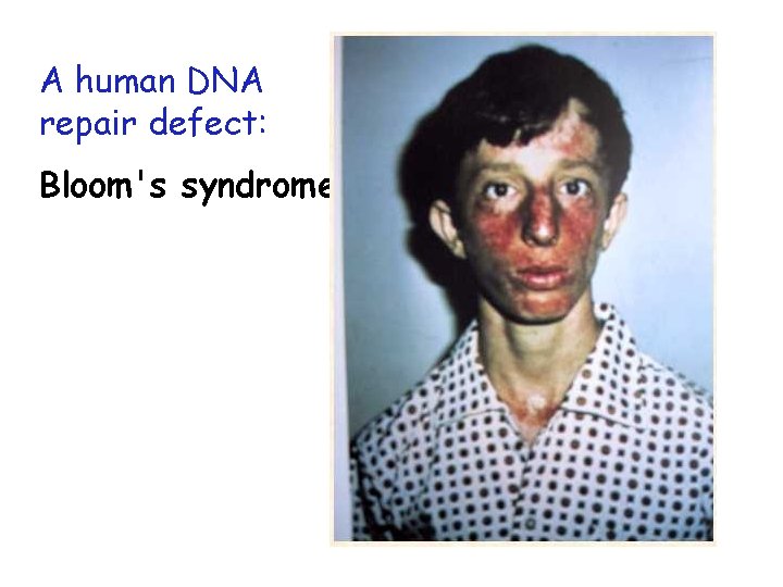 A human DNA repair defect: Bloom's syndrome 