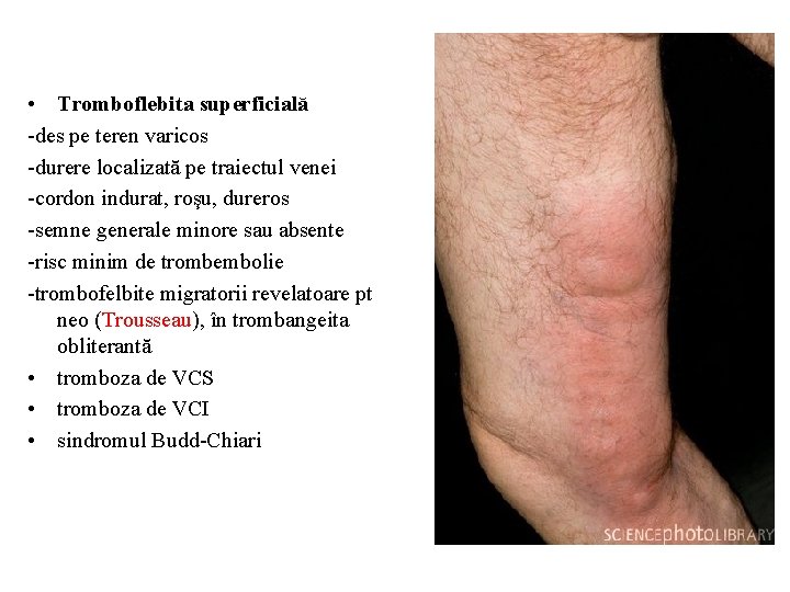 Arteriopatia cronica obliteranta a membrelor inferioare | Edu Polaris
