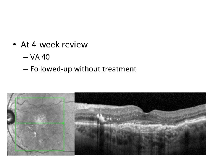 • At 4 -week review – VA 40 – Followed-up without treatment 