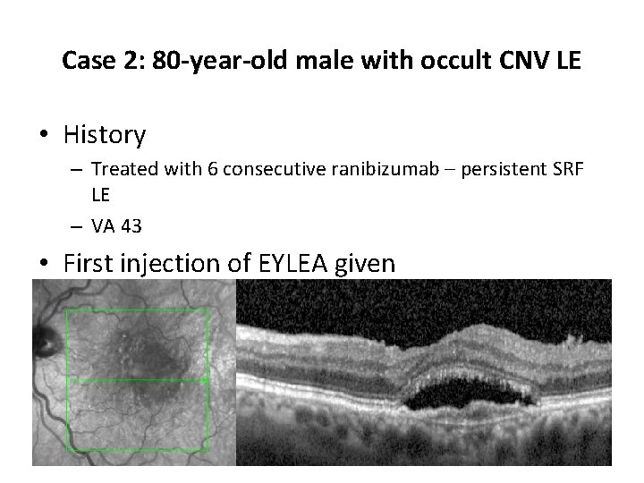 Case 2: 80 -year-old male with occult CNV LE • History – Treated with