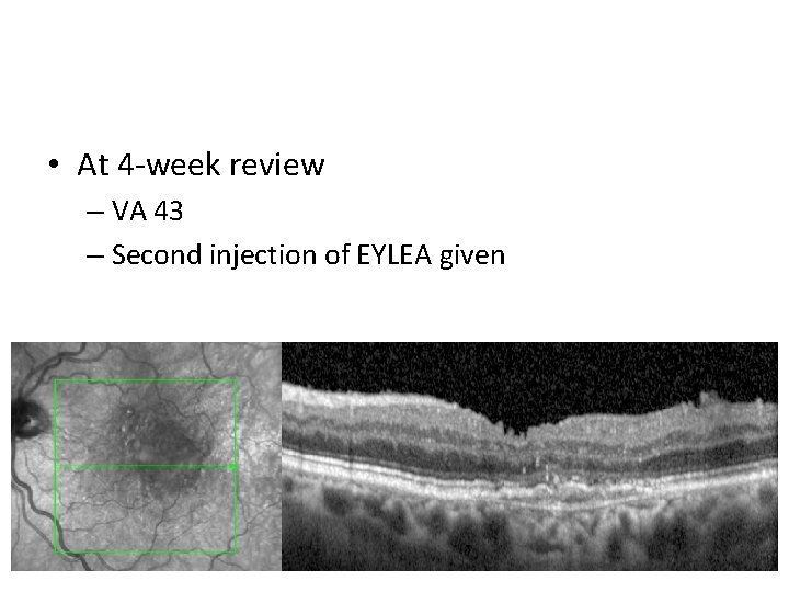  • At 4 -week review – VA 43 – Second injection of EYLEA