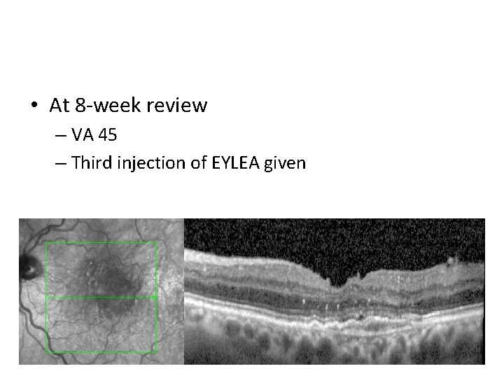  • At 8 -week review – VA 45 – Third injection of EYLEA