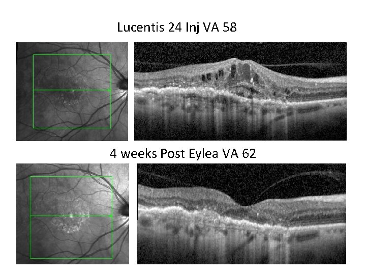 Lucentis 24 Inj VA 58 4 weeks Post Eylea VA 62 