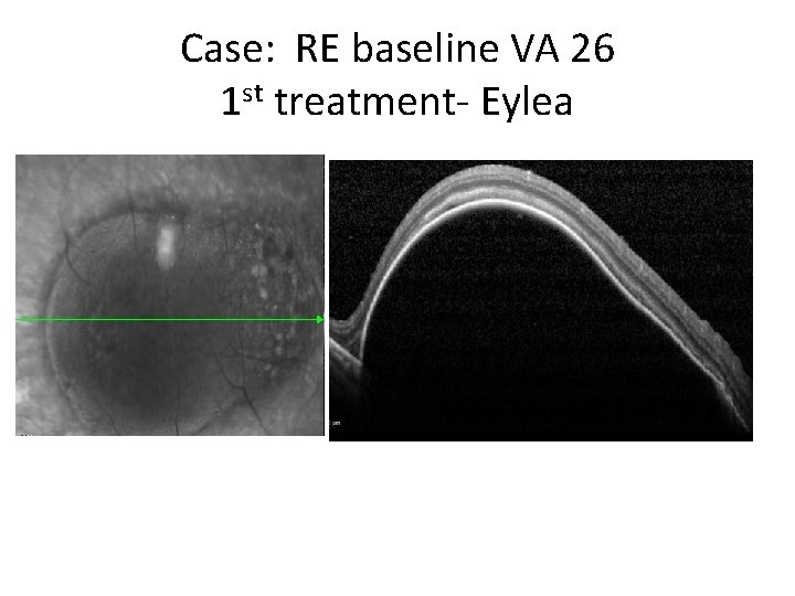 Case: RE baseline VA 26 1 st treatment- Eylea • VA 26 to 39