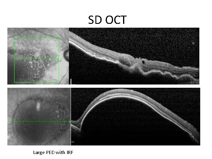  SD OCT • VA 26 to 39 Large PED with IRF 