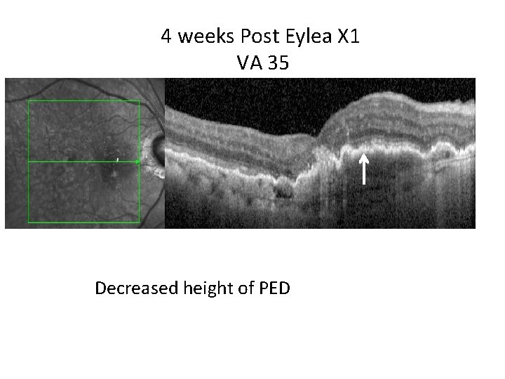 4 weeks Post Eylea X 1 VA 35 Decreased height of PED 