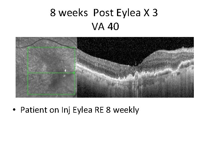 8 weeks Post Eylea X 3 VA 40 • Patient on Inj Eylea RE