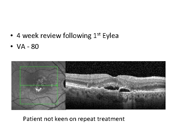  • 4 week review following 1 st Eylea • VA - 80 Patient