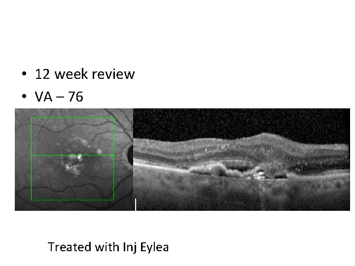  • 12 week review • VA – 76 Treated with Inj Eylea 