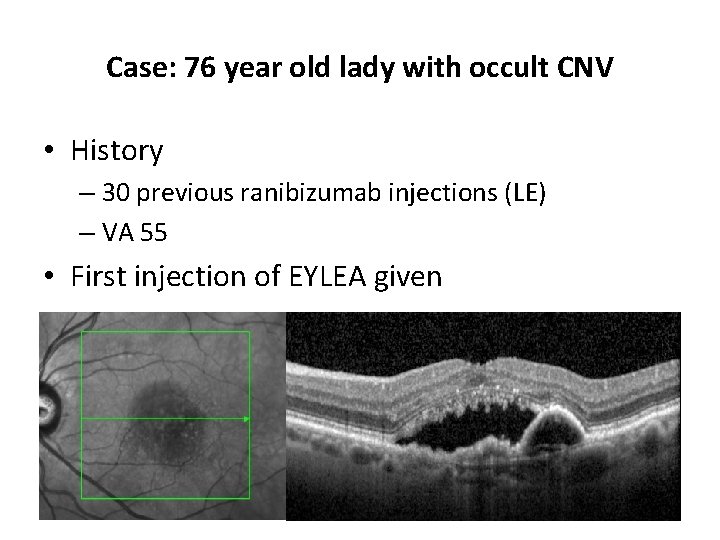 Case: 76 year old lady with occult CNV • History – 30 previous ranibizumab