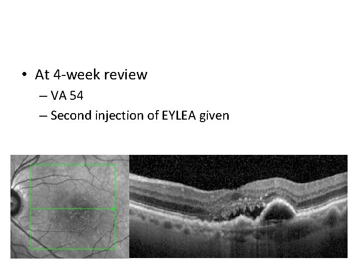  • At 4 -week review – VA 54 – Second injection of EYLEA