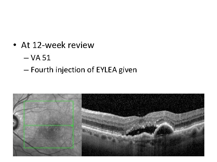  • At 12 -week review – VA 51 – Fourth injection of EYLEA