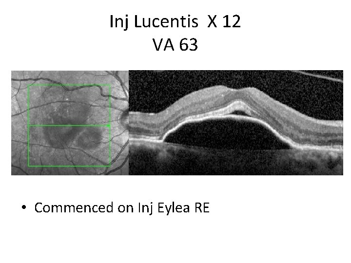 Inj Lucentis X 12 VA 63 • Commenced on Inj Eylea RE 