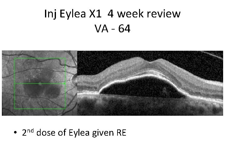 Inj Eylea X 1 4 week review VA - 64 • 2 nd dose
