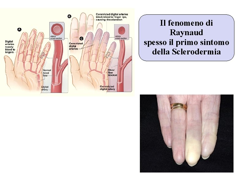 Il fenomeno di Raynaud spesso il primo sintomo della Sclerodermia Il fenomeno di Raynaud spesso il primo sintomo della Sclerodermia