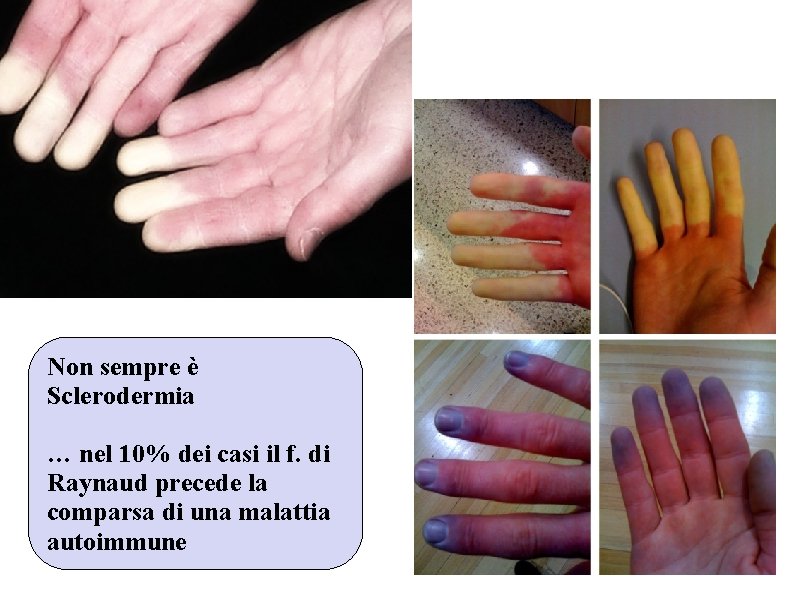 Non sempre è Sclerodermia … nel 10% dei casi il f. di Raynaud precede Non sempre è Sclerodermia … nel 10% dei casi il f. di Raynaud precede