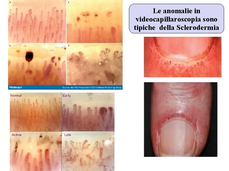 Le anomalie in videocapillaroscopia sono tipiche della Sclerodermia Le anomalie in videocapillaroscopia sono tipiche della Sclerodermia
