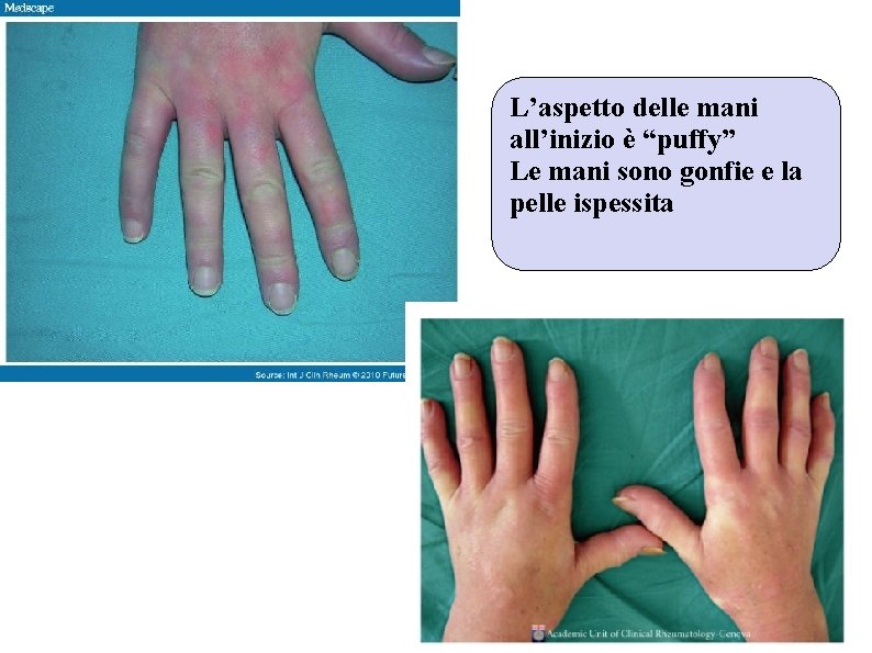 L’aspetto delle mani all’inizio è “puffy” Le mani sono gonfie e la pelle ispessita L’aspetto delle mani all’inizio è “puffy” Le mani sono gonfie e la pelle ispessita