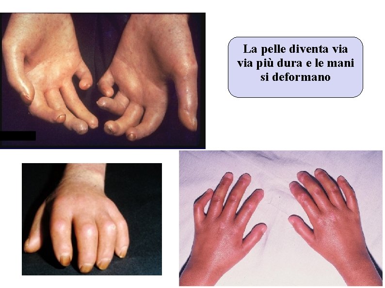 La pelle diventa via più dura e le mani si deformano La pelle diventa via più dura e le mani si deformano