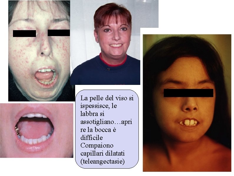 La pelle del viso si ispessisce, le labbra si assotigliano…apri re la bocca è La pelle del viso si ispessisce, le labbra si assotigliano…apri re la bocca è