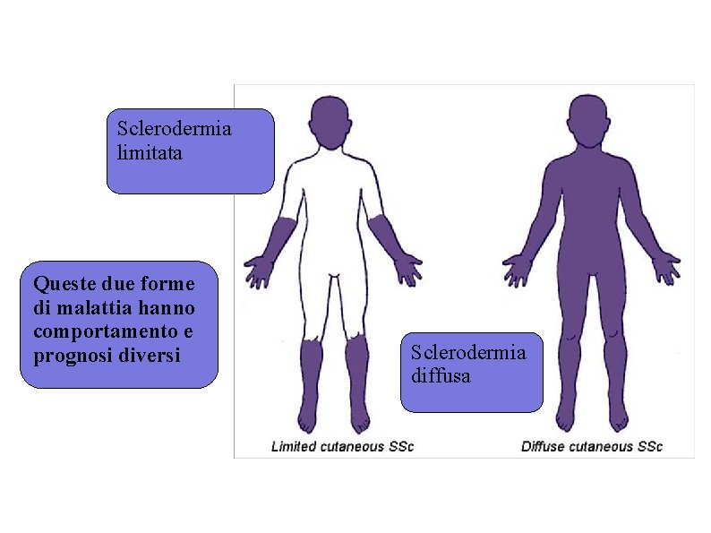 Sclerodermia limitata Queste due forme di malattia hanno comportamento e prognosi diversi Sclerodermia diffusa Sclerodermia limitata Queste due forme di malattia hanno comportamento e prognosi diversi Sclerodermia diffusa