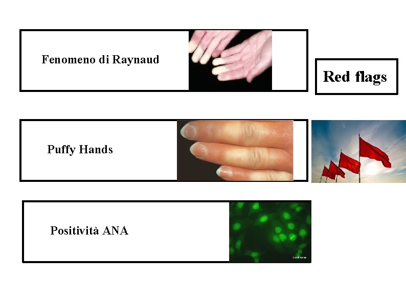 Fenomeno di Raynaud Red flags Puffy Hands Positività ANA Fenomeno di Raynaud Red flags Puffy Hands Positività ANA