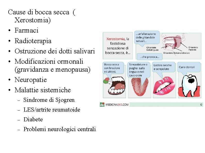 Cause di bocca secca ( Xerostomia) • Farmaci • Radioterapia • Ostruzione dei dotti Cause di bocca secca ( Xerostomia) • Farmaci • Radioterapia • Ostruzione dei dotti