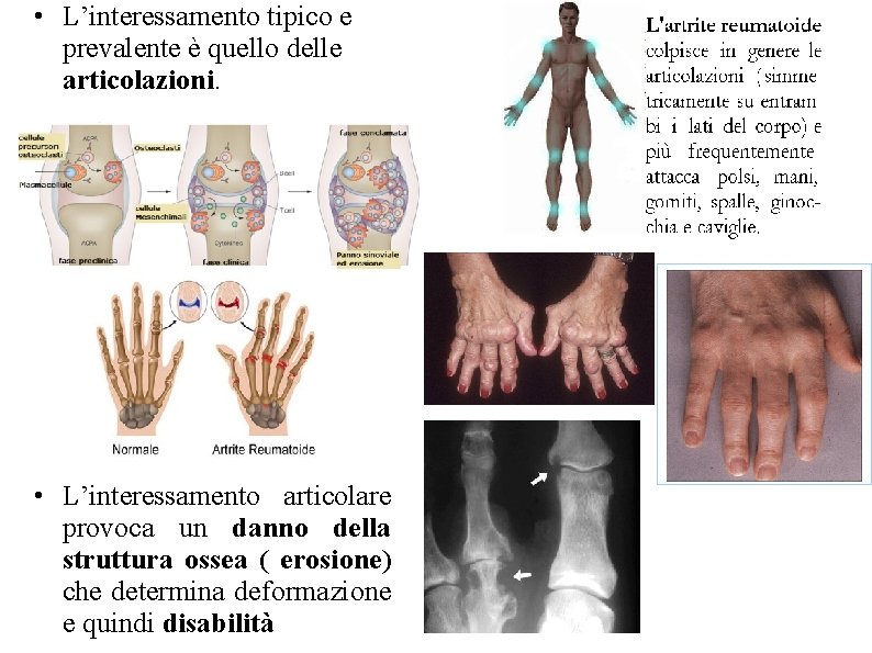 • L’interessamento tipico e prevalente è quello delle articolazioni. • L’interessamento articolare provoca • L’interessamento tipico e prevalente è quello delle articolazioni. • L’interessamento articolare provoca