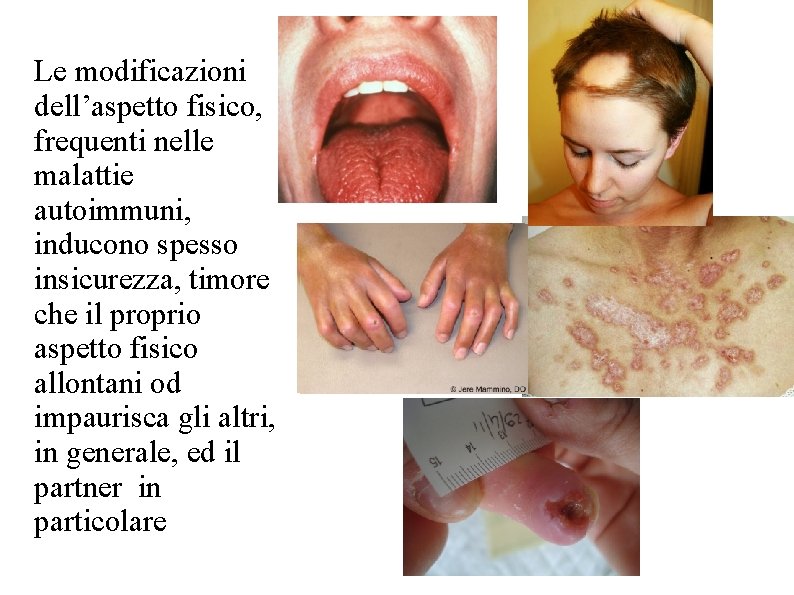 Le modificazioni dell’aspetto fisico, frequenti nelle malattie autoimmuni, inducono spesso insicurezza, timore che il Le modificazioni dell’aspetto fisico, frequenti nelle malattie autoimmuni, inducono spesso insicurezza, timore che il
