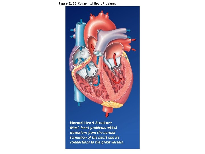 Figure 21 -35 Congenital Heart Problems Normal Heart Structure Most heart problems reflect deviations Figure 21 -35 Congenital Heart Problems Normal Heart Structure Most heart problems reflect deviations