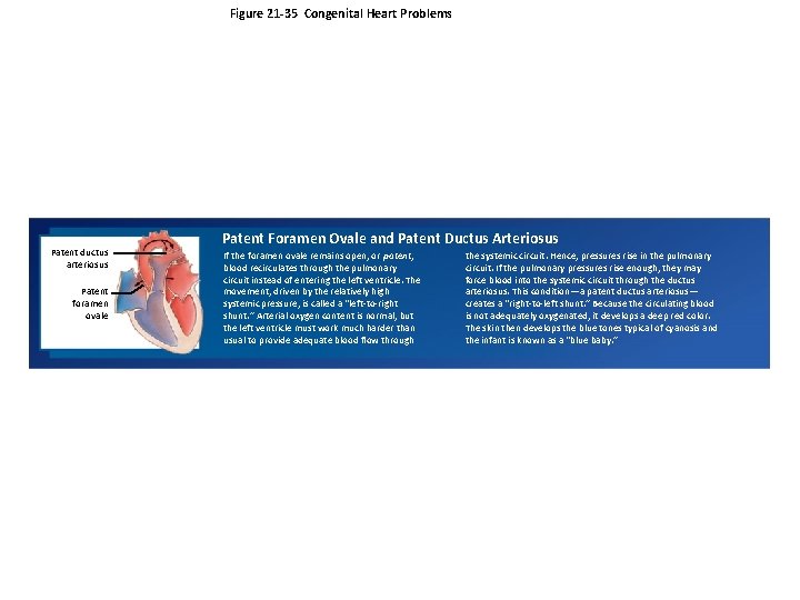 Figure 21 -35 Congenital Heart Problems Patent ductus arteriosus Patent foramen ovale Patent Foramen