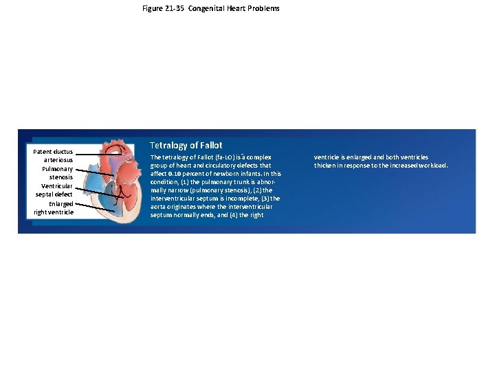 Figure 21 -35 Congenital Heart Problems Patent ductus arteriosus Pulmonary stenosis Ventricular septal defect Figure 21 -35 Congenital Heart Problems Patent ductus arteriosus Pulmonary stenosis Ventricular septal defect
