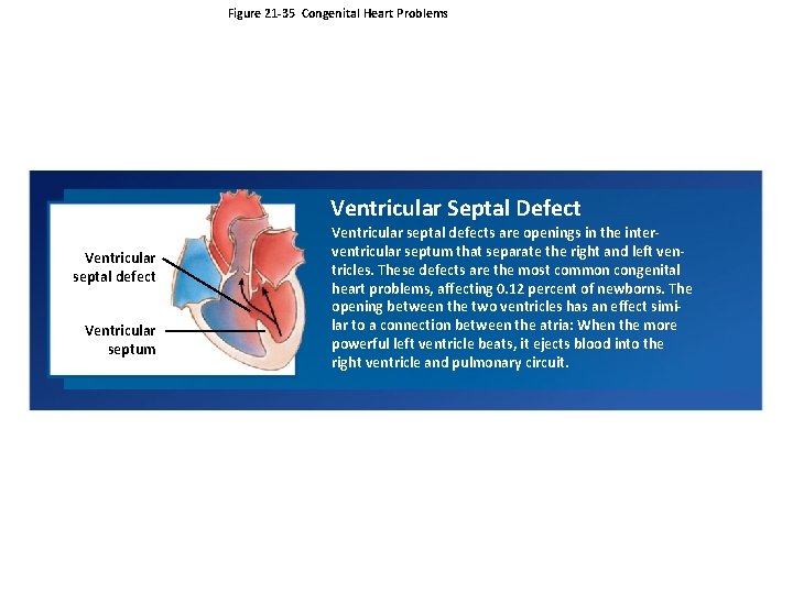 Figure 21 -35 Congenital Heart Problems Ventricular Septal Defect Ventricular septal defect Ventricular septum