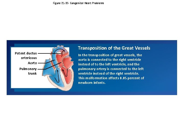 Figure 21 -35 Congenital Heart Problems Patent ductus arteriosus Aorta Pulmonary trunk Transposition of