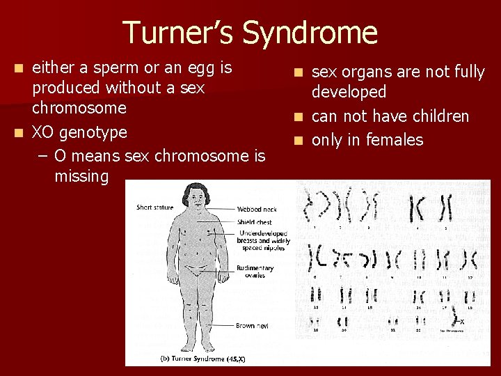 Turner’s Syndrome either a sperm or an egg is produced without a sex chromosome