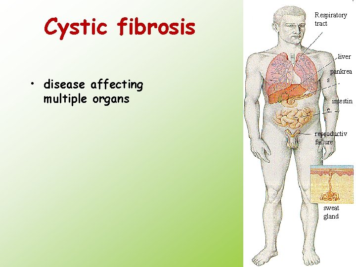 Cystic fibrosis Respiratory tract liver • disease affecting multiple organs pankrea s intestin e
