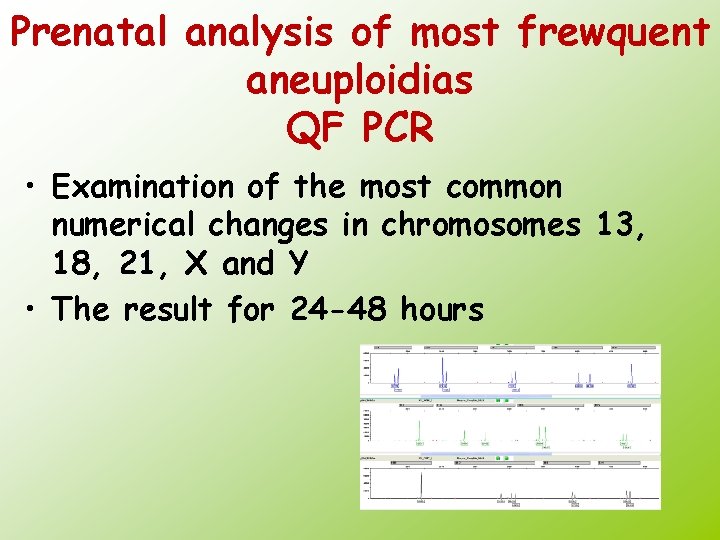 Prenatal analysis of most frewquent aneuploidias QF PCR • Examination of the most common