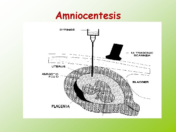 Amniocentesis 
