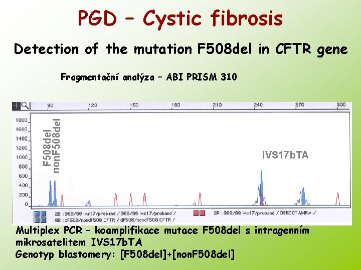 PGD – Cystic fibrosis Detection of the mutation F 508 del in CFTR gene