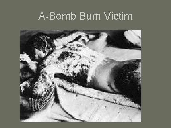 A-Bomb Burn Victim 