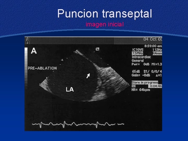 Puncion transeptal imagen inicial 