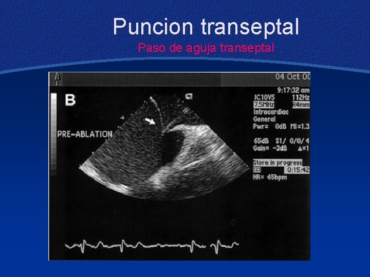 Puncion transeptal Paso de aguja transeptal 