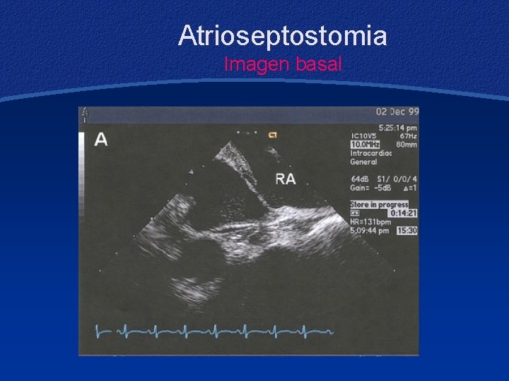 Atrioseptostomia Imagen basal 