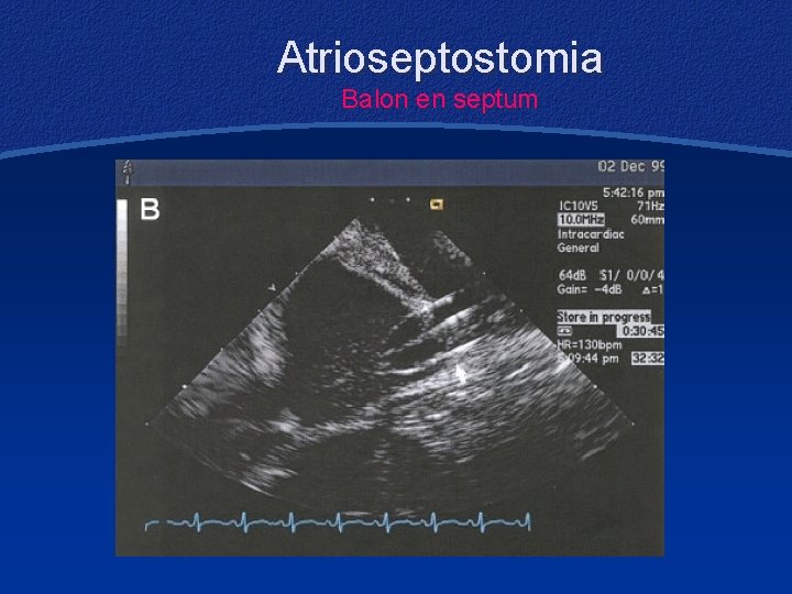 Atrioseptostomia Balon en septum 